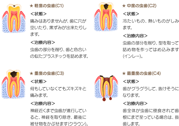 虫歯の段階、症状